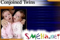 8-недельных сиамских близнецов начали готовить к разделению в США